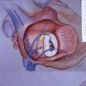 ablation
