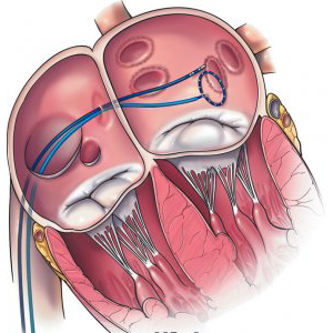 afib