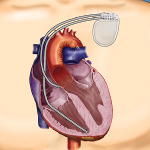 defib